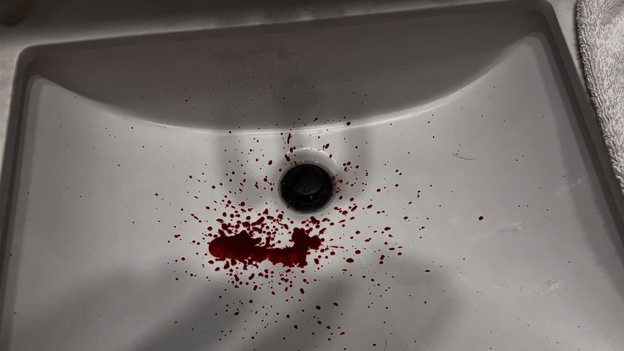 Bloody Nose
